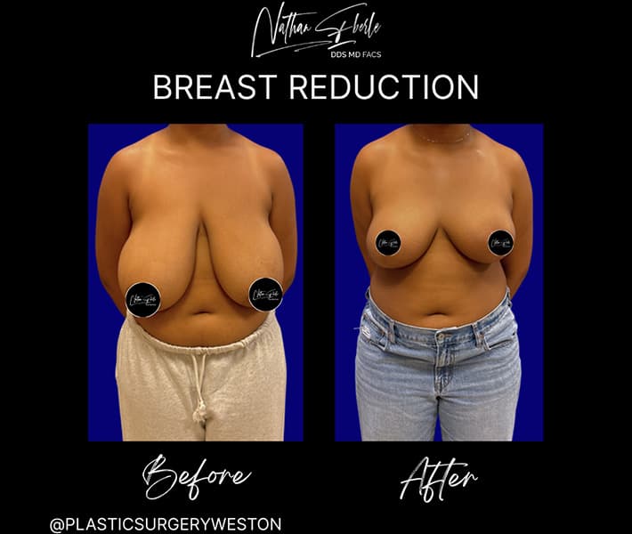 Breast Reduction before and after case 20, actual patient at Weston Center for Plastic Surgery