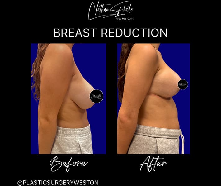 Breast Reduction before and after case 21, actual patient at Weston Center for Plastic Surgery
