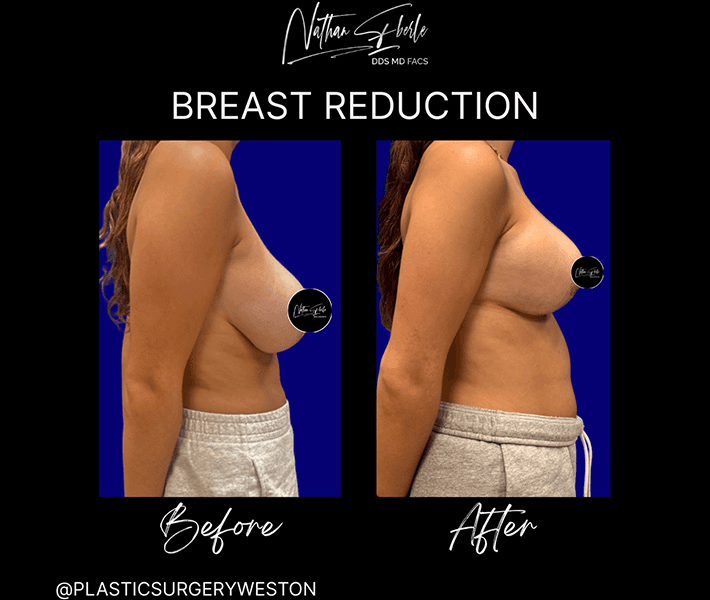 Breast Reduction case 21 before and after results at Weston Center for Plastic Surgery