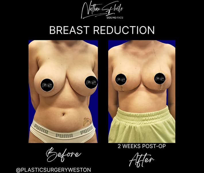 Breast Reduction before and after case 22, actual patient at Weston Center for Plastic Surgery