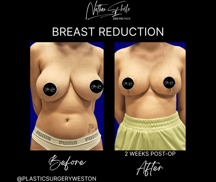 Breast Reduction case 22 before and after results at Weston Center for Plastic Surgery