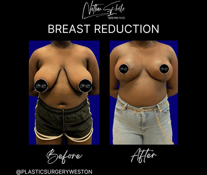Breast Reduction before and after case 23, actual patient at Weston Center for Plastic Surgery