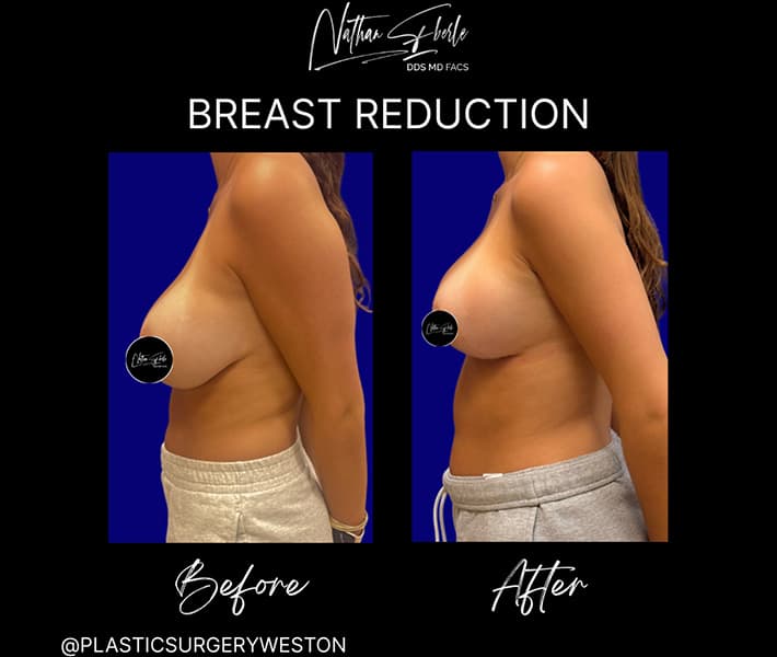 Breast Reduction before and after case 24, actual patient at Weston Center for Plastic Surgery