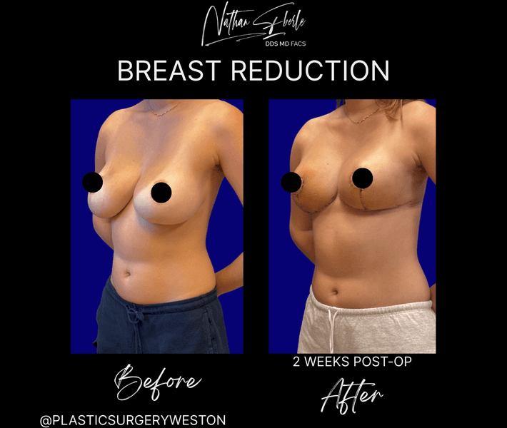 Breast Reduction case 25 before and after results at Weston Center for Plastic Surgery