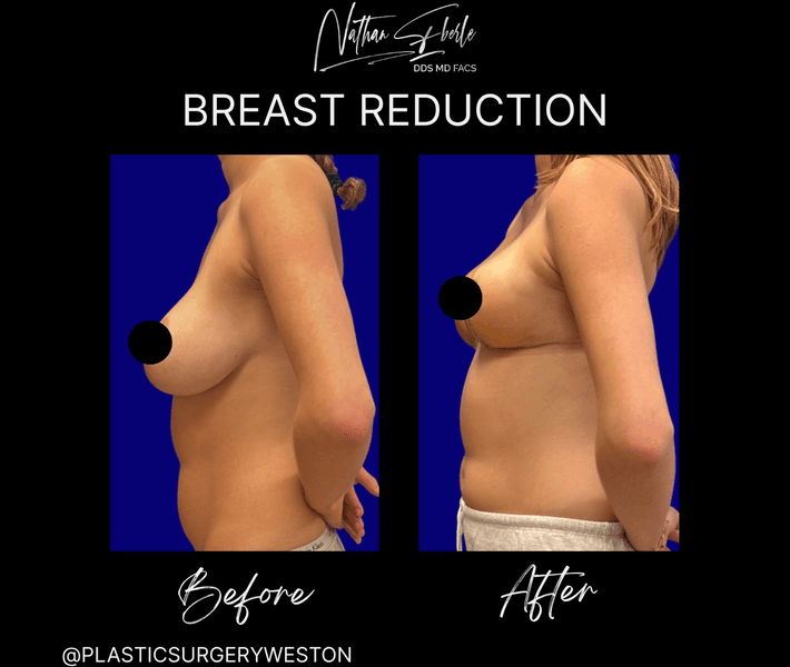 Breast Reduction case 26 before and after results at Weston Center for Plastic Surgery
