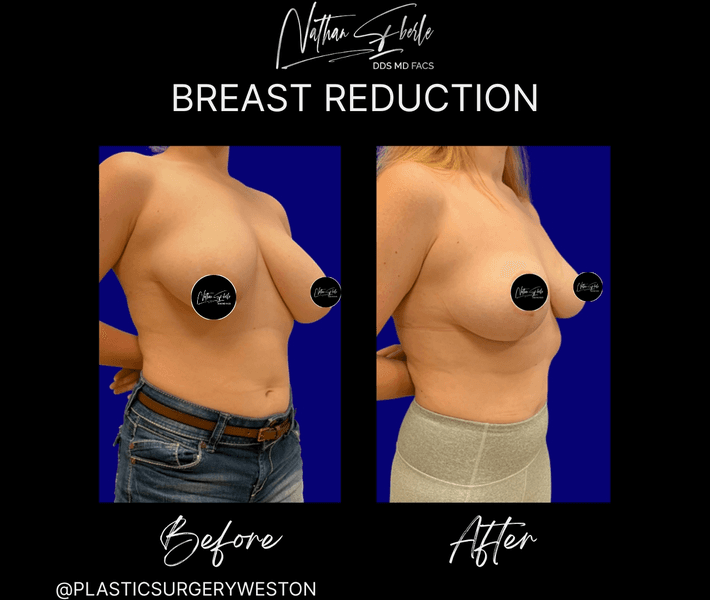 Breast Reduction case 27 before and after results at Weston Center for Plastic Surgery