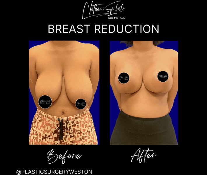 Breast Reduction case 28 before and after results at Weston Center for Plastic Surgery
