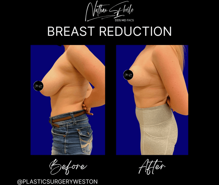 Breast Reduction case 29 before and after results at Weston Center for Plastic Surgery