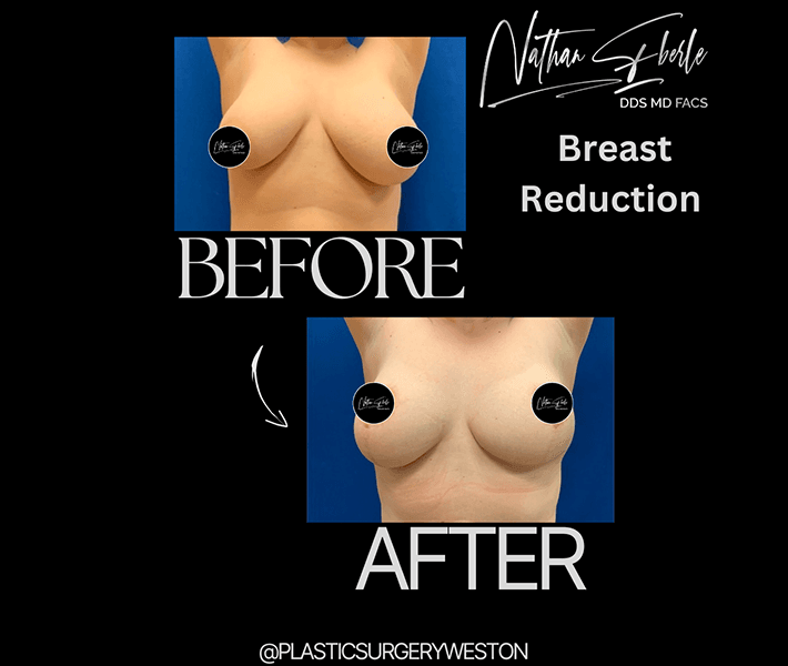Breast Reduction before and after case 3, actual patient at Weston Center for Plastic Surgery