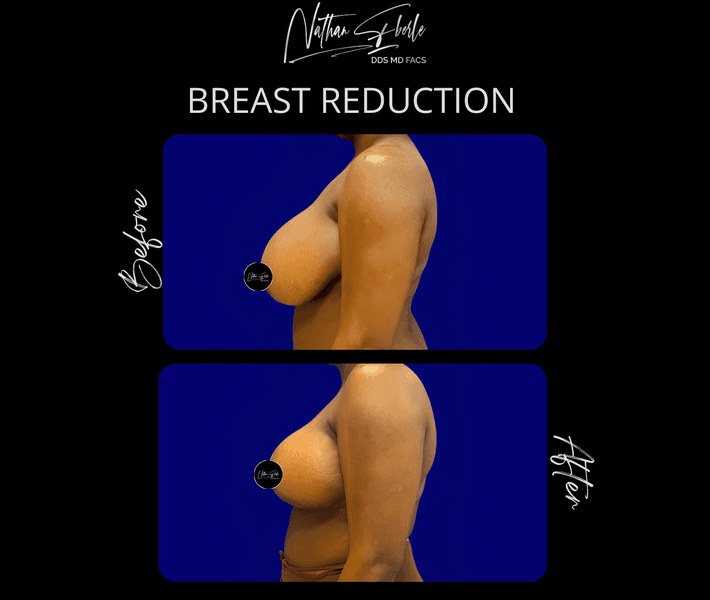 Breast Reduction case 30 before and after results at Weston Center for Plastic Surgery