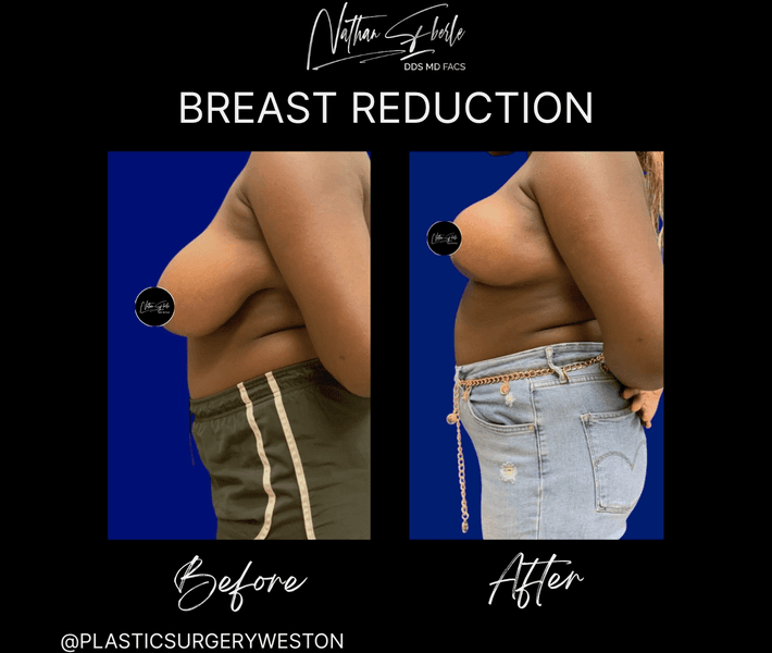 Breast Reduction case 31 before and after results at Weston Center for Plastic Surgery
