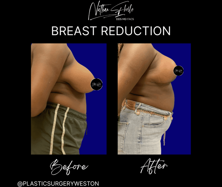 Breast Reduction case 32 before and after results at Weston Center for Plastic Surgery