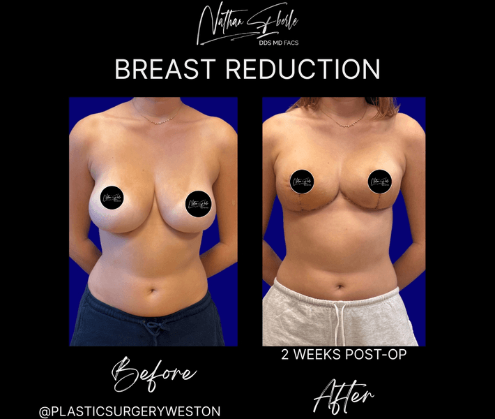 Breast Reduction case 33 before and after results at Weston Center for Plastic Surgery