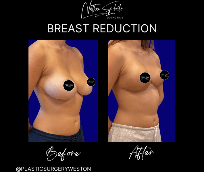 Breast Reduction case 34 before and after results at Weston Center for Plastic Surgery
