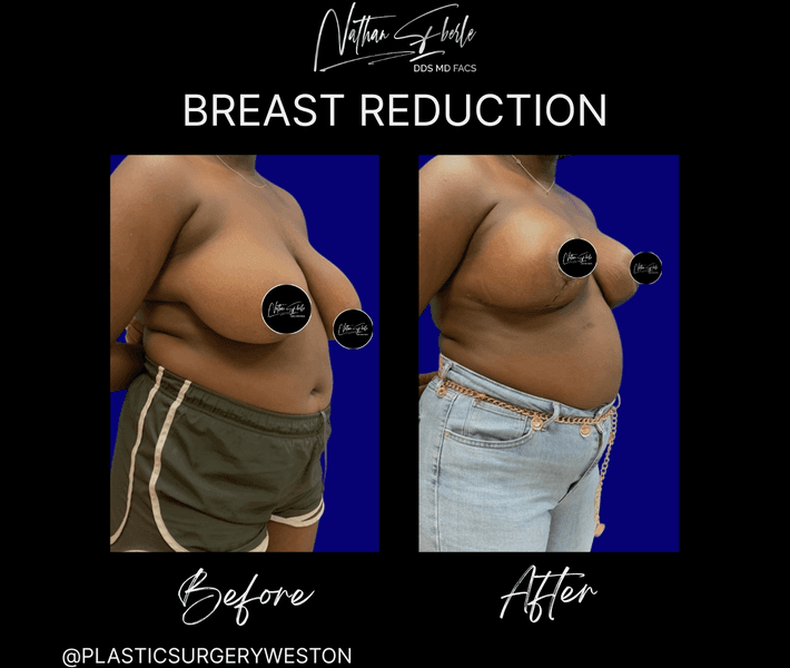 Breast Reduction case 35 before and after results at Weston Center for Plastic Surgery