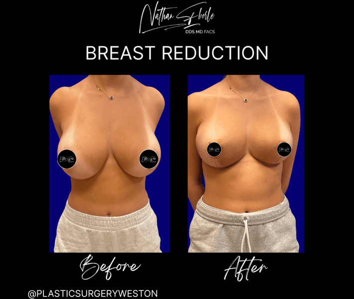 Breast Reduction case 36 before and after results at Weston Center for Plastic Surgery