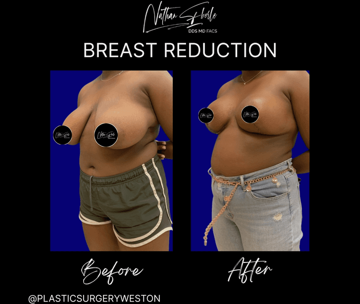 Breast Reduction case 37 before and after results at Weston Center for Plastic Surgery