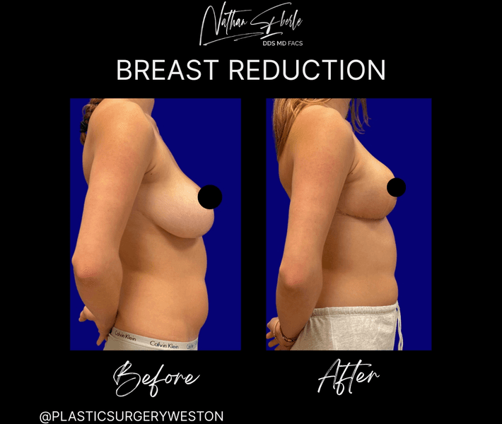 Breast Reduction case 38 before and after results at Weston Center for Plastic Surgery