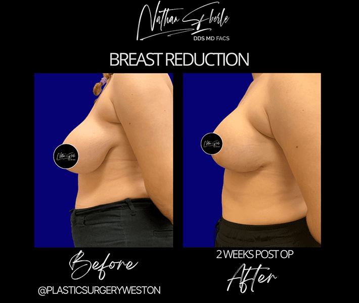 Breast Reduction before and after case 4, actual patient at Weston Center for Plastic Surgery