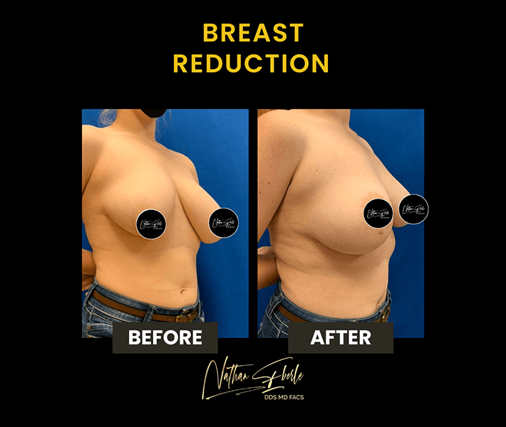 Breast Reduction before and after case 5, actual patient at Weston Center for Plastic Surgery