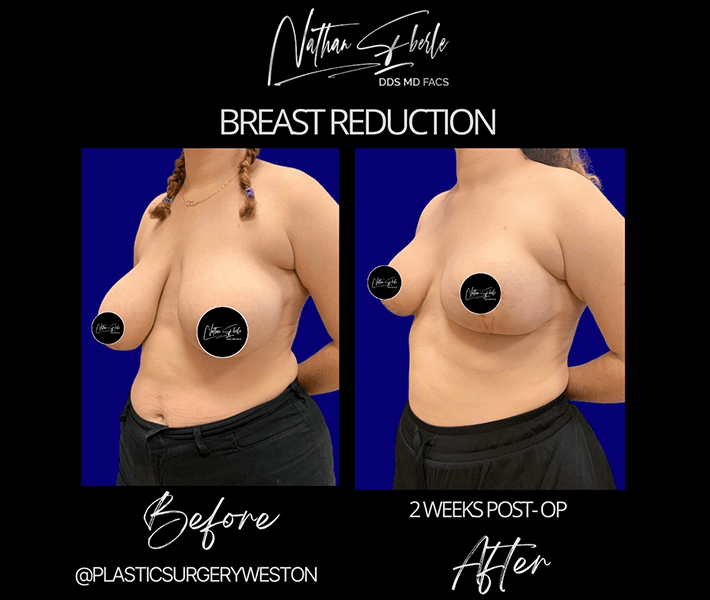 Breast Reduction before and after case 6, actual patient at Weston Center for Plastic Surgery