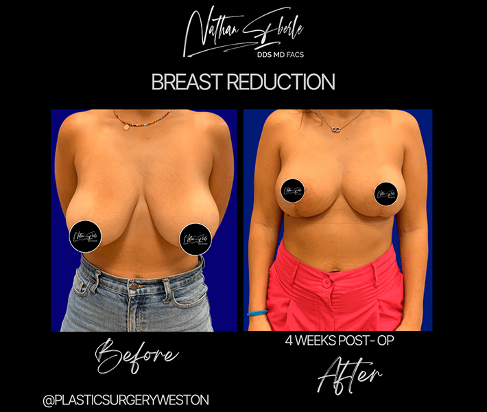 Breast Reduction before and after case 7, actual patient at Weston Center for Plastic Surgery
