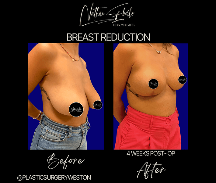Breast Reduction before and after case 8, actual patient at Weston Center for Plastic Surgery