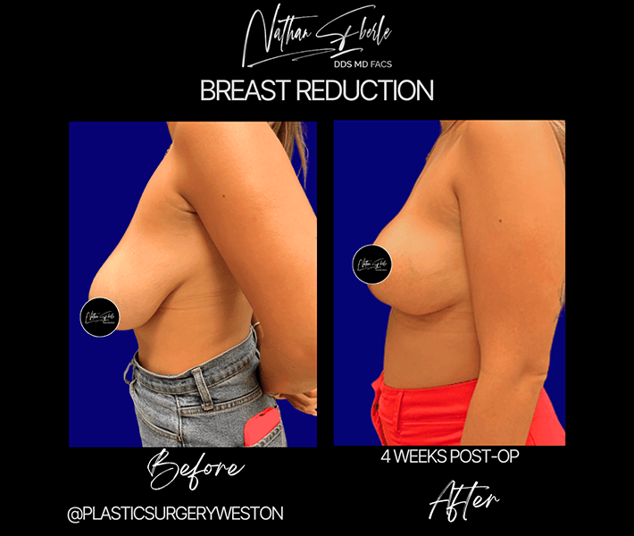 Breast Reduction before and after case 9, actual patient at Weston Center for Plastic Surgery