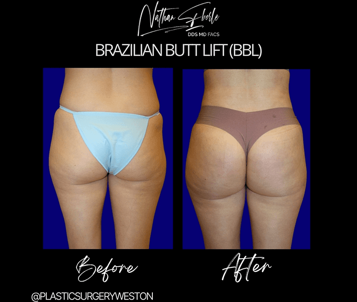 Buttock Lift (BBL) before and after case 2, actual patient at Weston Center for Plastic Surgery