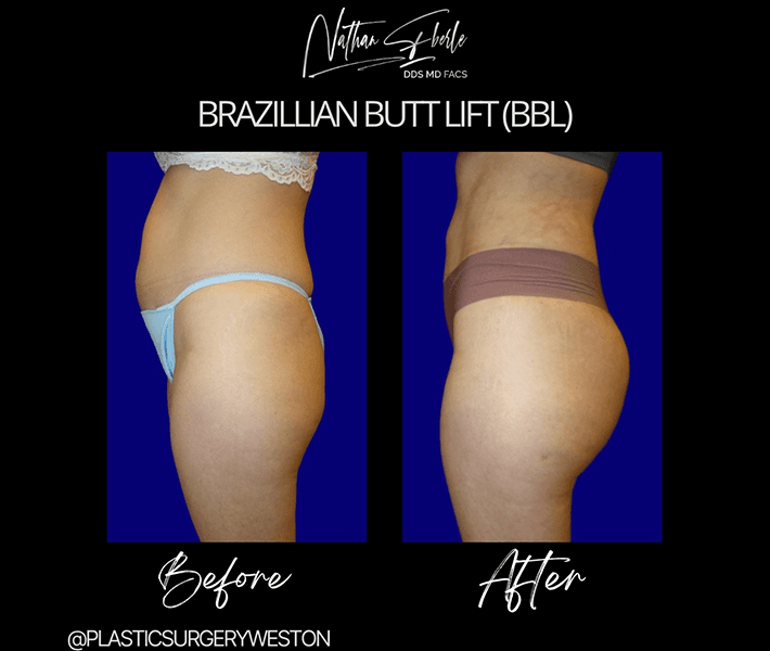 Buttock Lift (BBL) before and after case 3, actual patient at Weston Center for Plastic Surgery