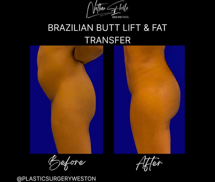 Buttock Lift (BBL) before and after case 4, actual patient at Weston Center for Plastic Surgery