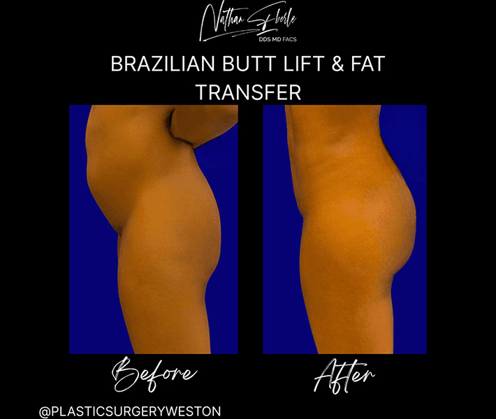 Buttock Lift (BBL) before and after case 4, actual patient at Weston Center for Plastic Surgery