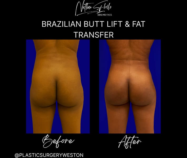 Buttock Lift (BBL) before and after case 5, actual patient at Weston Center for Plastic Surgery