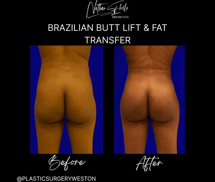 Buttock Lift case 5 before and after results at Weston Center for Plastic Surgery
