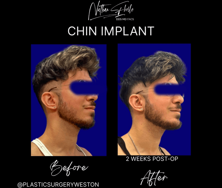Chin Implant case 10 before and after results at Weston Center for Plastic Surgery