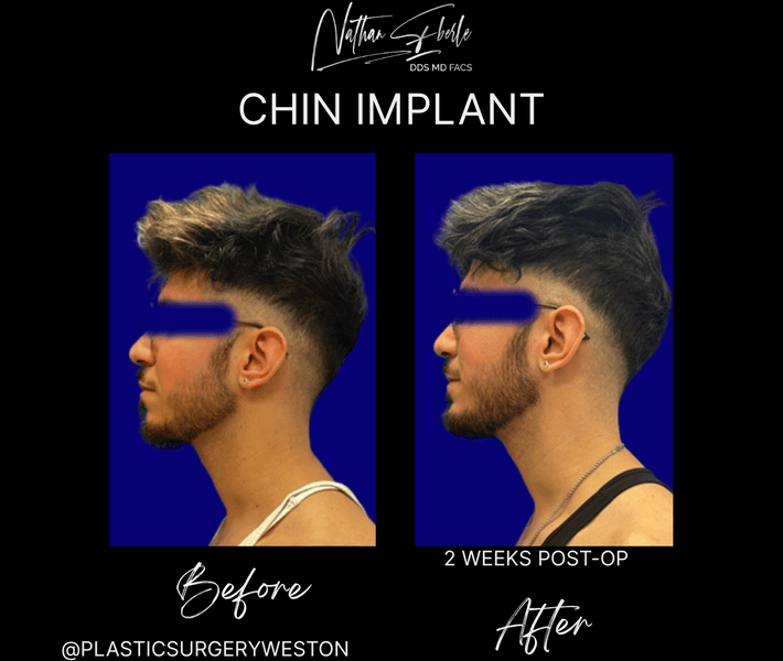 Chin Implant case 11 before and after results at Weston Center for Plastic Surgery