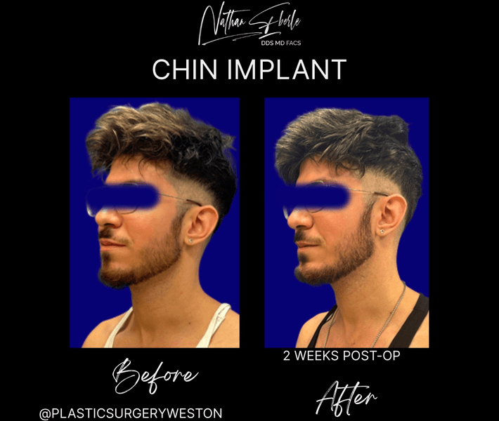 Chin Implant case 12 before and after results at Weston Center for Plastic Surgery