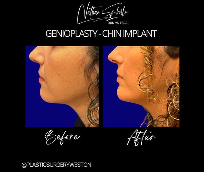 Chin implant case 1 before and after