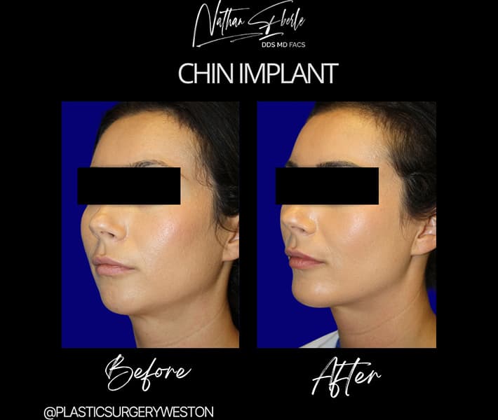 Chin implant case 2 before and after