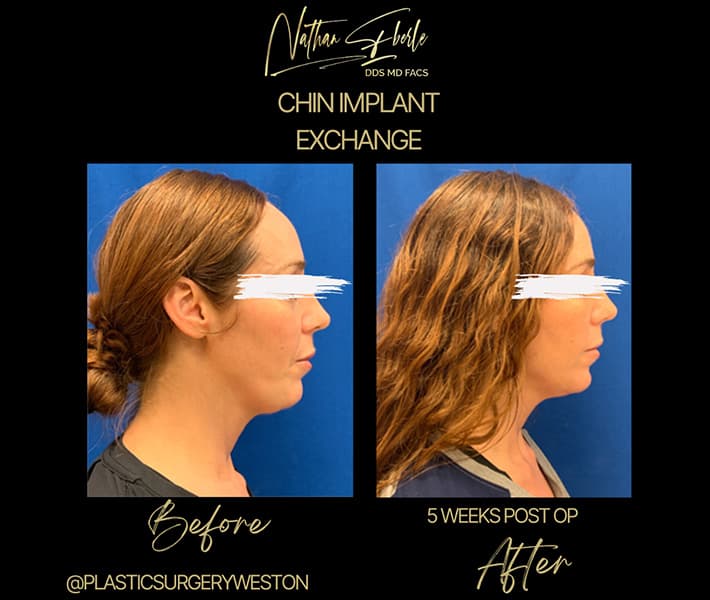 Chin Implant before and after case 5, actual patient at Weston Center for Plastic Surgery