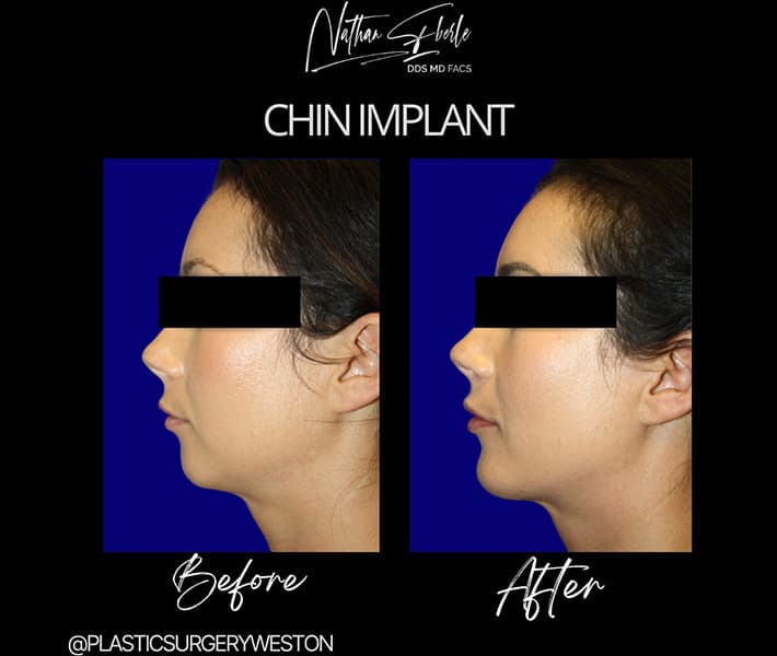 Chin Implant before and after case 6, actual patient at Weston Center for Plastic Surgery