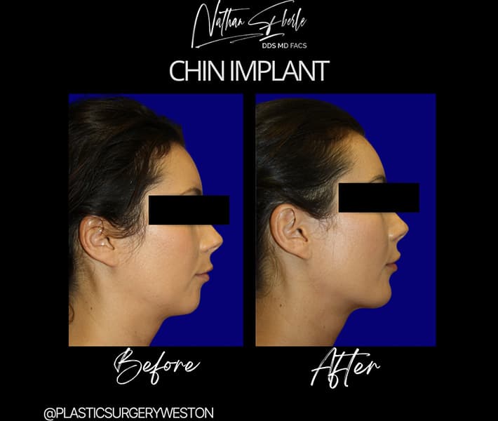 Chin Implant before and after case 7, actual patient at Weston Center for Plastic Surgery
