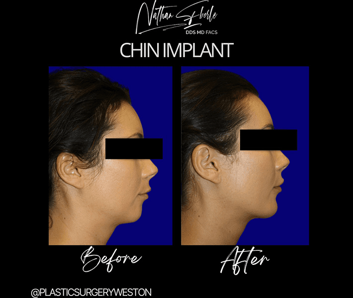 Chin Implant case 7 before and after results at Weston Center for Plastic Surgery