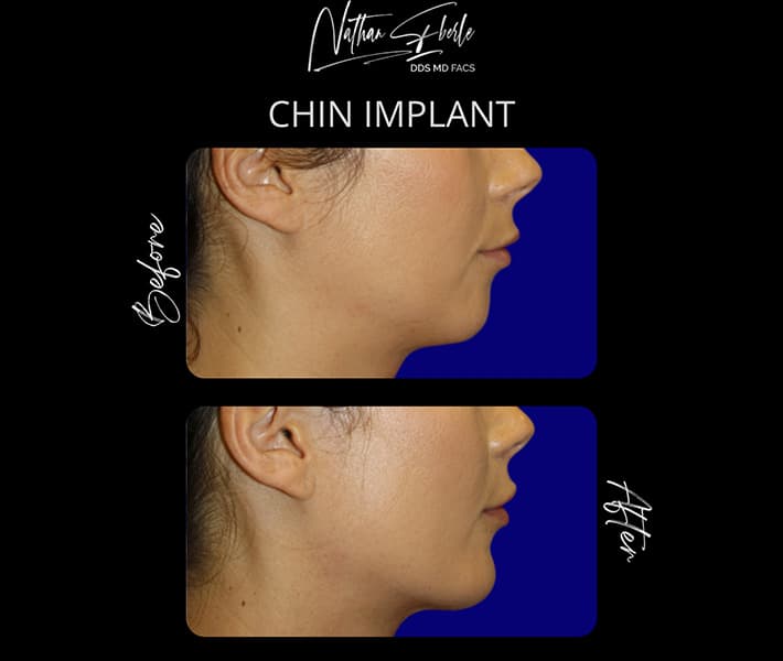 Chin Implant before and after case 9, actual patient at Weston Center for Plastic Surgery