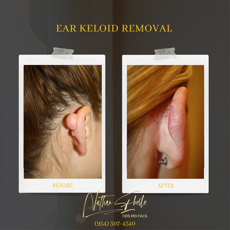 Ear Keloid Removal before and after case 1, actual patient at Weston Center for Plastic Surgery