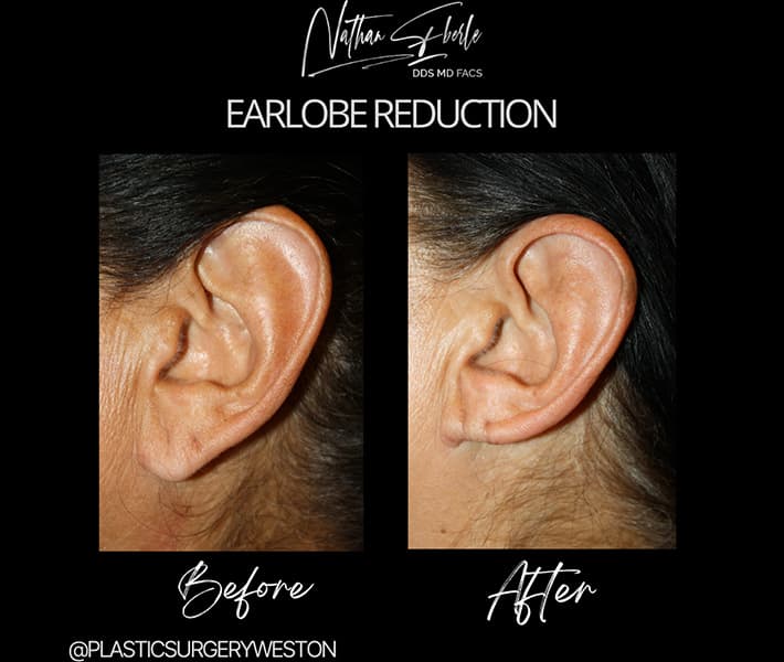 Earlobe Reduction before and after case 1, actual patient at Weston Center for Plastic Surgery
