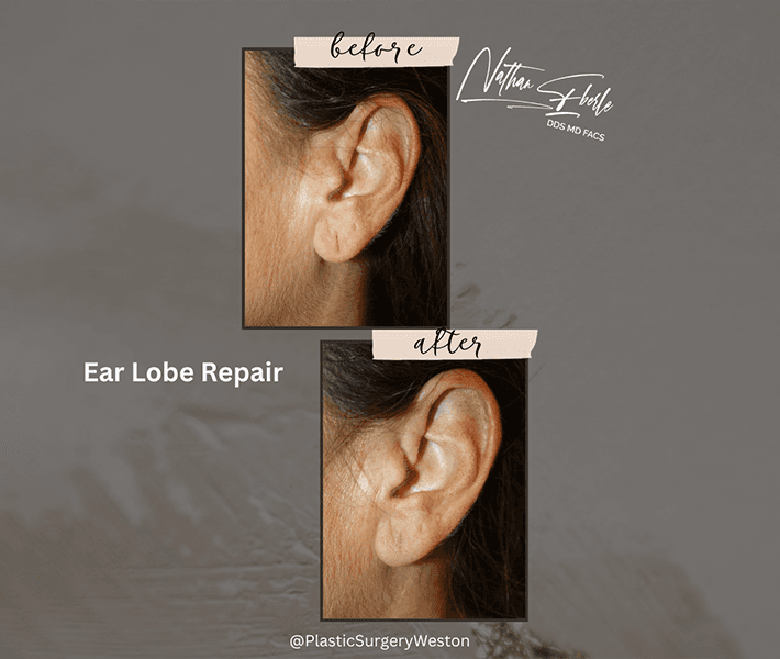 Earlobe Repair before and after case 1, actual patient at Weston Center for Plastic Surgery