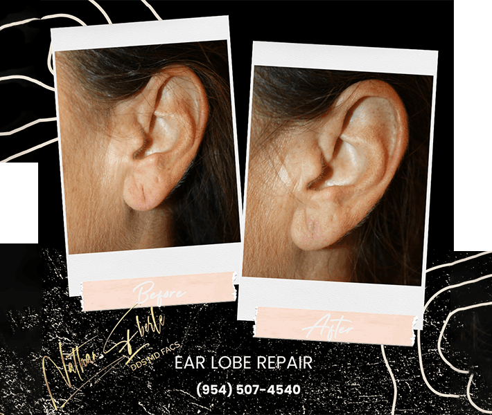 Earlobe Repair before and after case 10, actual patient at Weston Center for Plastic Surgery