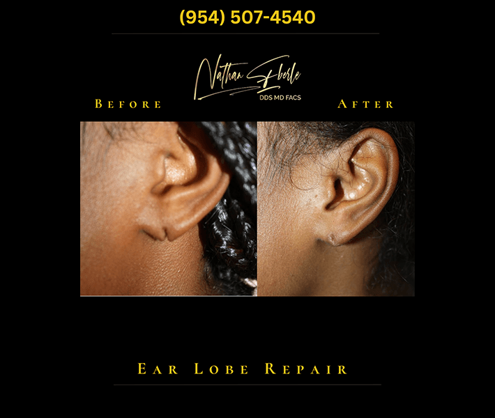 Earlobe Repair before and after case 11, actual patient at Weston Center for Plastic Surgery