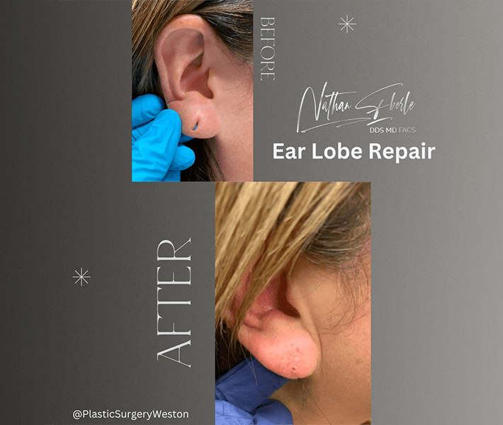 Earlobe Repair before and after case 12, actual patient at Weston Center for Plastic Surgery